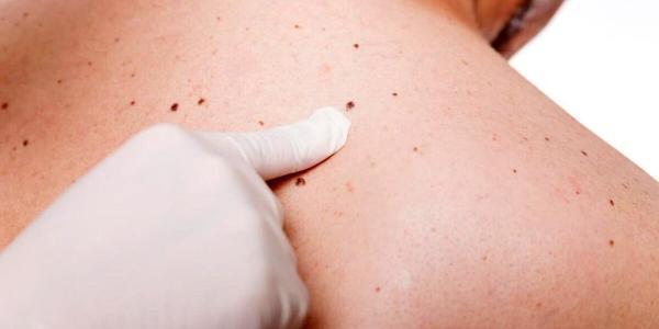 درمان سرطان پوست با یک روش نو